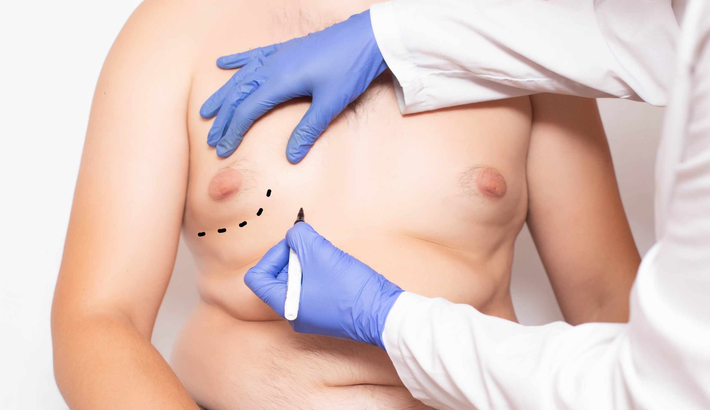 For men only plastic surgery gynaecomastia 